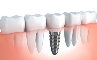 dr muttha dental clinic Dental  Implant